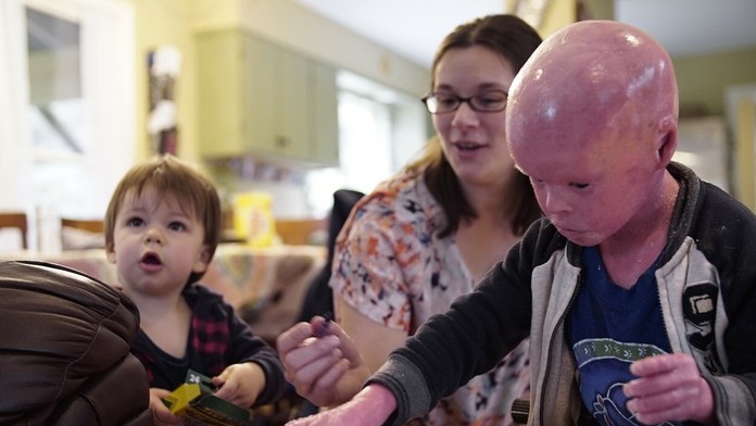 Chlapček trpí unikátnou chorobu. Abnormálne rýchlo mu rastie koža.
