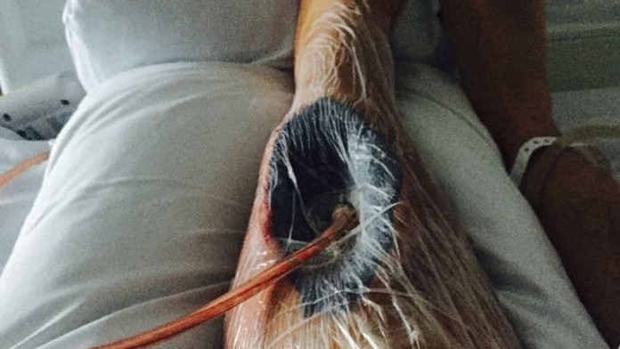 Lewisovi Brownovi museli vyrezať z nohy sval.