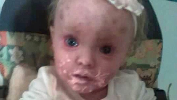 Paige Milby má genetickú chorobu.