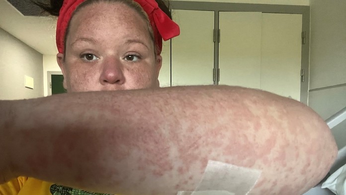 Ženu bodol na dovolenke nebezpečný hmyz. V reakcii s antibiotikami jej opadávali koža, vlasy aj nechty