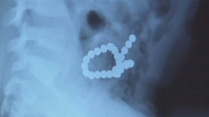 Malý Noah zjedol magnetky z chladničky.