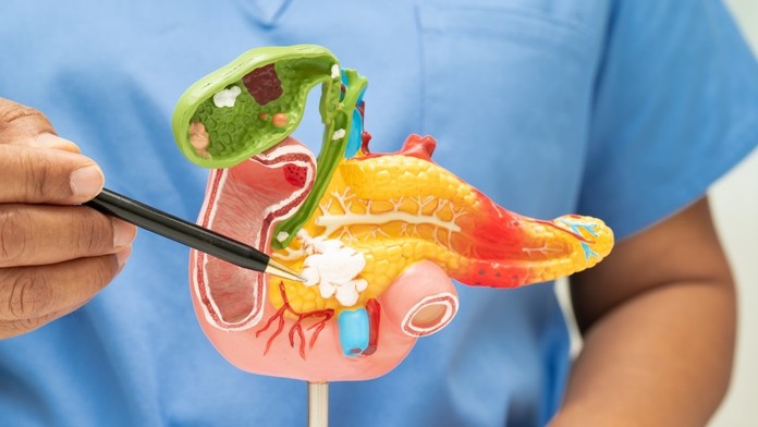 Rakovina pankreasu (ilustračná snímka)