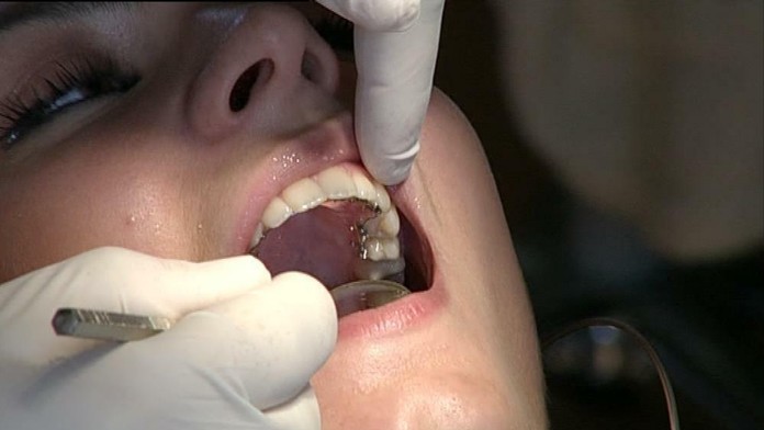 Strojček na zuby - 2