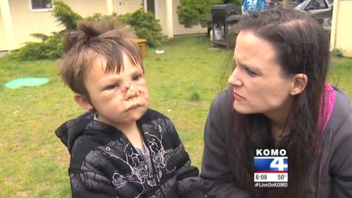 Gavina Tobecka napadol pitbul. 