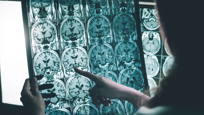 Nádej pre nespočetné množstvo ľudí. Lekári našli nový spôsob včasného odhalenia Alzheimera