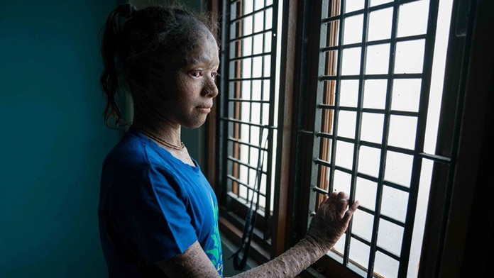 Vedika Gupta musí žiť v izolácii.