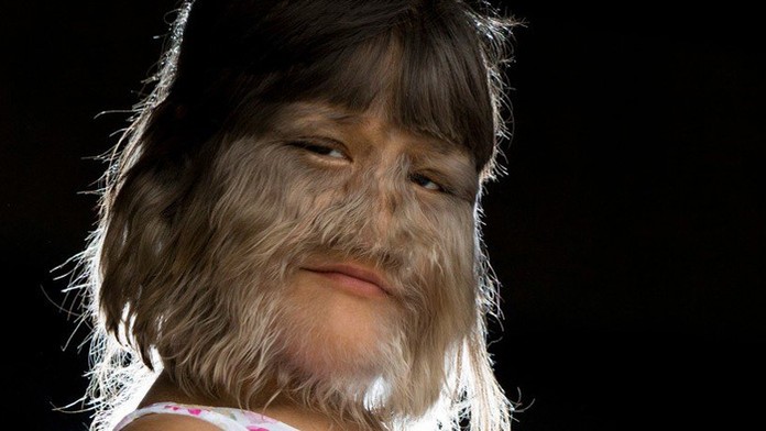 Supatra prešla laserovou terapiou a našla si prvú lásku.