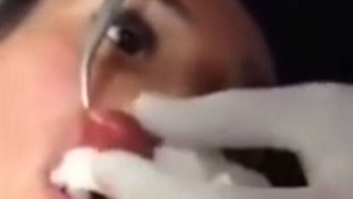 Lekár vytiahne žene z hornej pery živého červa.