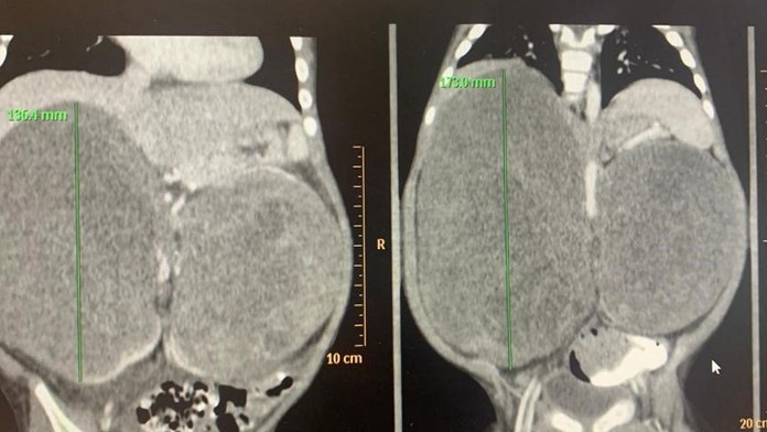 Raritné operácie zachránili život malému chlapčekovi.