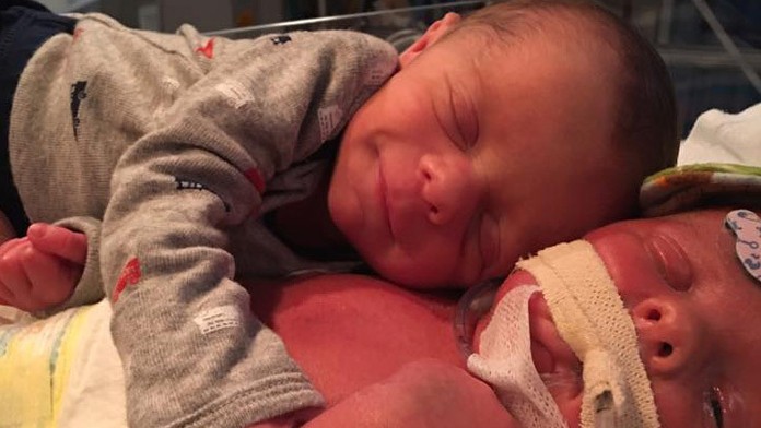 Snímka, ktorá láme srdce. Bábätko objíma svoje umierajúce dvojča