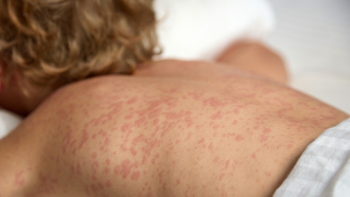 Európou sa vo veľkom šíria osýpky. WHO už hlási aj obete