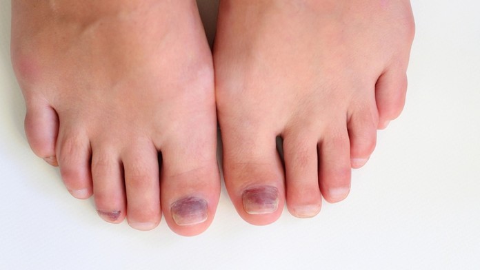 Myslela si, že ide iba o kozmetický problém. Z modriny pod nechtom sa vykľula zákerná choroba