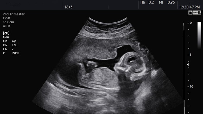 Žene počas unikátnej operácie vybrali z tela maternicu aj s dieťaťom. Môj syn sa narodil dvakrát, hovorí mamička