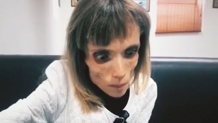 Kristina Karyagina trpí anorexiou