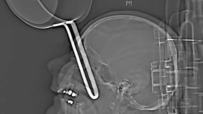 Nemec si vrazil panvicu do lebky