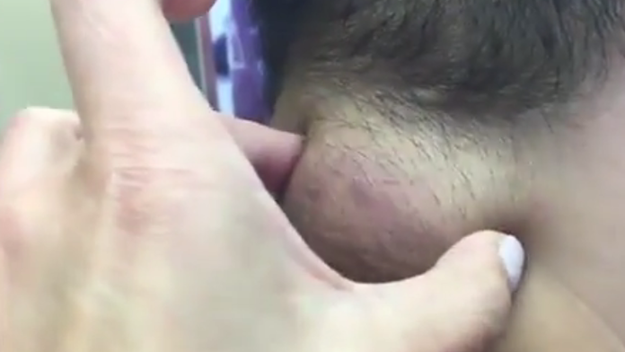 Hrča veľká ako golfová loptička