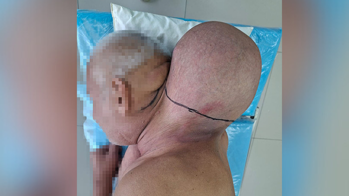 Lekári ostali v šoku: Muž žil 16 rokov s nádorom veľkým ako hlava