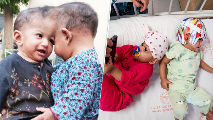 Po úspešnom zákroku budú môcť siamské dvojičky žiť plnohodnotný život.