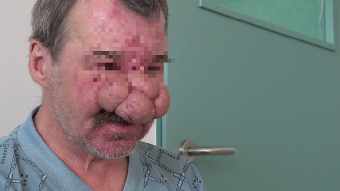 Nos mu nekontrolovane rástol.