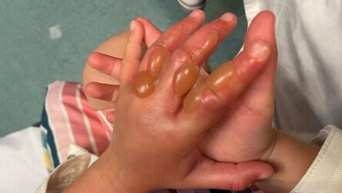 Dievča sa popŕhlilo o jedovatú rastlinu, skončilo s pľuzgiermi. Invázny druh rastie aj u nás