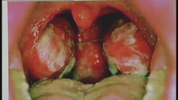 Choroba bozkávania.