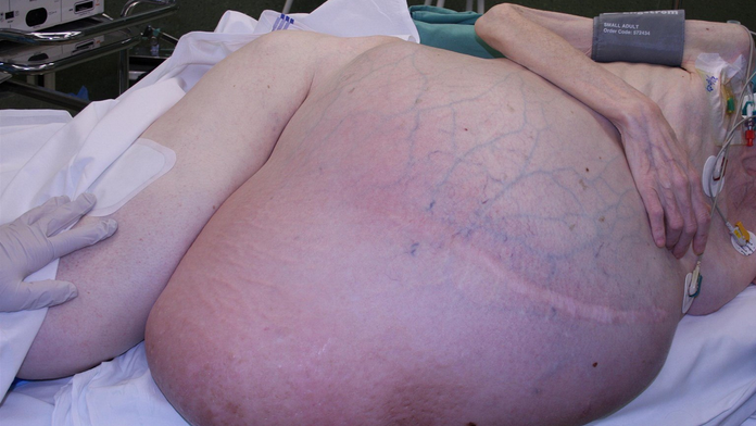 Zhubný tumor vážil 36 kíl