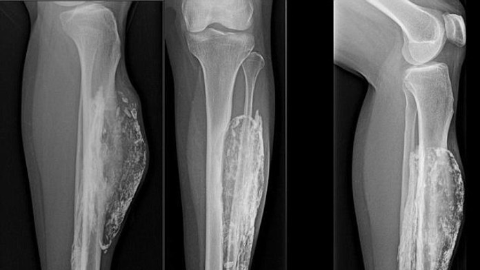 Noha pohrýzenej Thajčanky