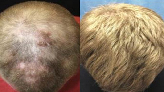 Alopecia areata