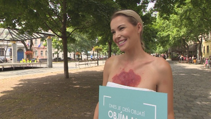 Strašiak menom psoriáza.