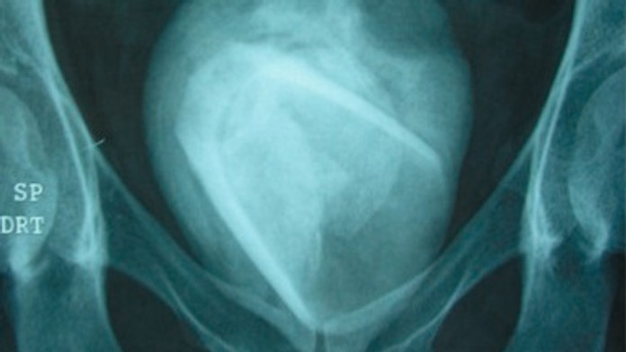 Lekárov prekvapil nález v tele ženy. Gigantický obličkový kameň obsahoval nečakaný predmet