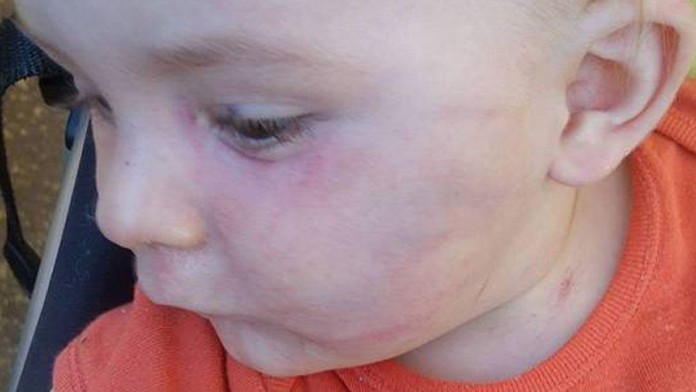 Malý Adamko má na tvári pomliaždeniny.