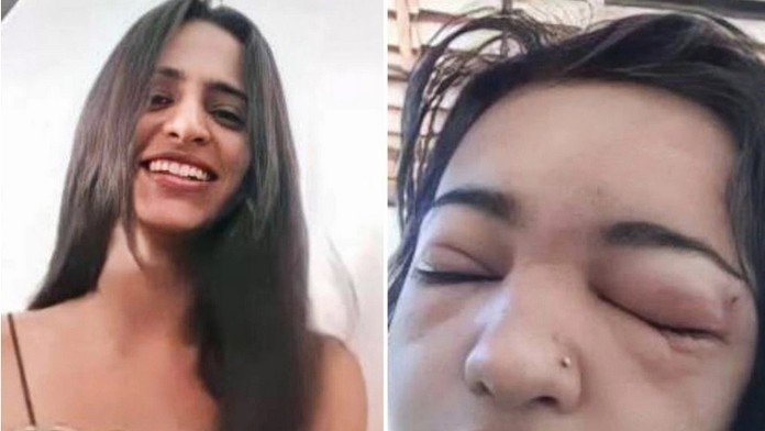 Izabela vpravo už s infekciou.