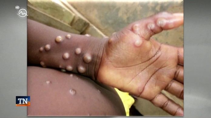 Svetová zdravotnícka organizácia vyhlásila pre opičie kiahne medzinárodný stav ohrozenia