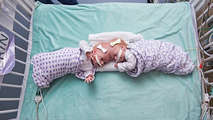 Vo Filadelfii oddelili desaťmesačné siamské dvojčatá spojené hlavami.