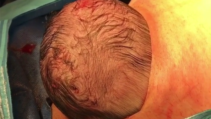 Prirodzený cisársky rez. 