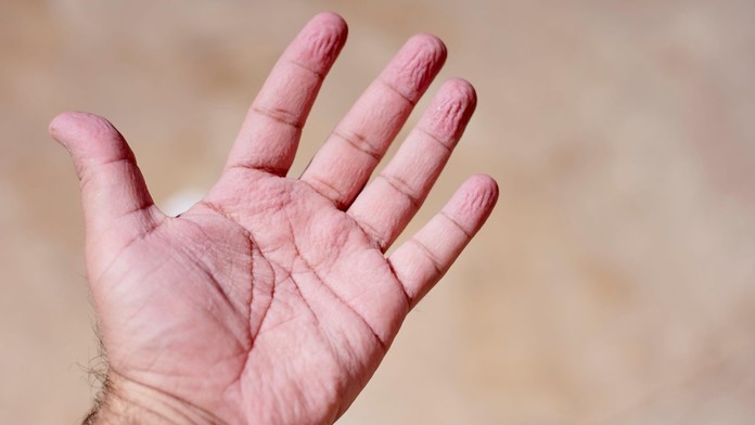 Zvráskavené prsty (ilustračná snímka)