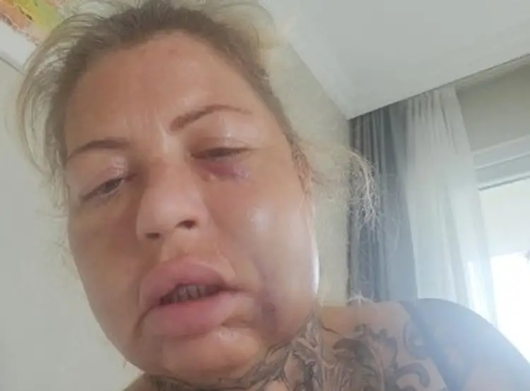 Vicky Robinsonová po zákroku v Turecku
