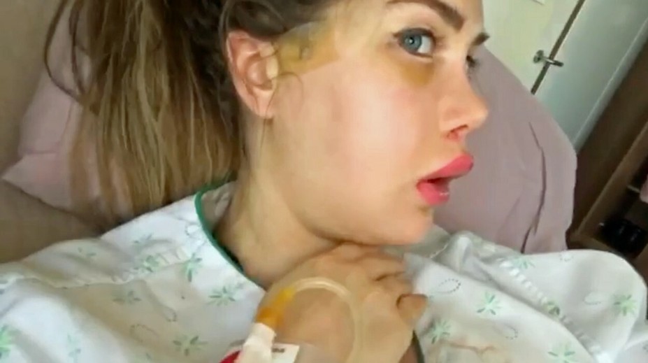 Chce vyzerať ako superhrdinka. Nechala si zlomiť sánku, takto vyzerá teraz