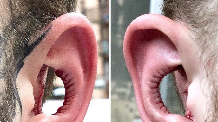 Muž precestoval pol zemegule, aby si nechal vyoperovať časť ucha. Vraj lepšie počuje