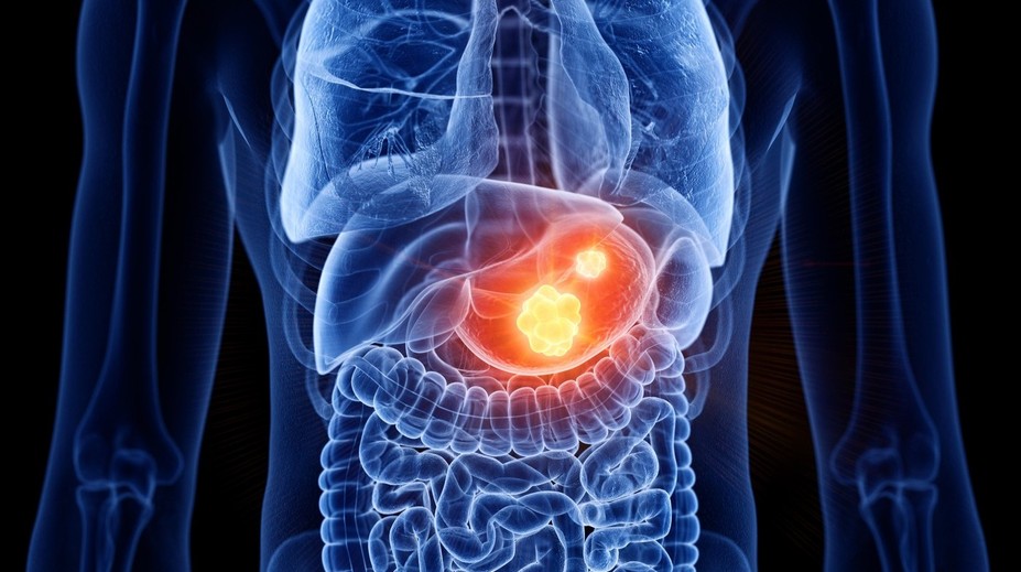 Nenápadná baktéria môže spustiť vážne ochorenie. Odborníci radia, čo robiť, aby ľudia predišli rakovine žalúdka