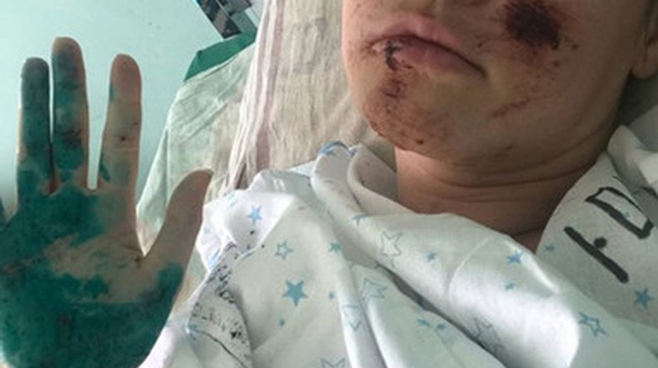 Hrozivá autonehoda. Vicemisska skončila na vozíku