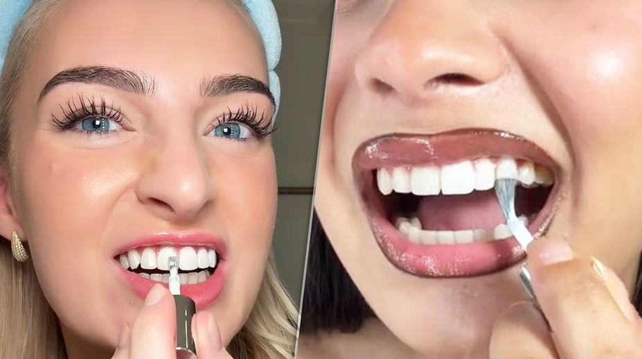 Biely úsmev za sekundu? Dentálna hygienička vysvetľuje, čo sa skrýva za virálnym lakom na zuby