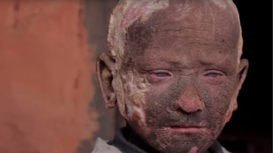 Ťažký osud chlapca: Pred očami bezbranných rodičov sa mení na skalu