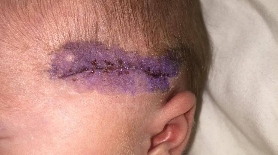 Rodila cisárskym rezom. Lekár porezal hlavičku bábätka