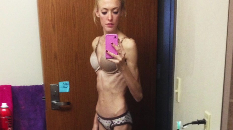 Bola som kostra. Tia pre anorexiu krvácala z nosa a bolelo ju celé telo