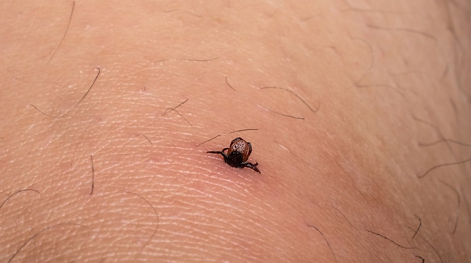 Zostal vám po vybratí kúsok kliešťa v koži? Lekárka radí, čo s ním určite nerobiť