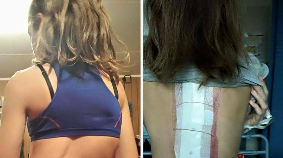 Dievča trpí vzácnou chorobou. Chrbticu mala o 55 stupňov vykrivenú
