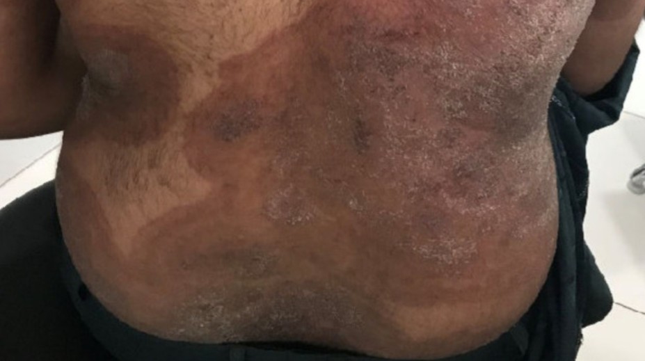 Európou sa valí superpleseň: Vedci varujú, že o chvíľu pred ňou nebude úniku. Postihuje celé telo, liečba je náročná