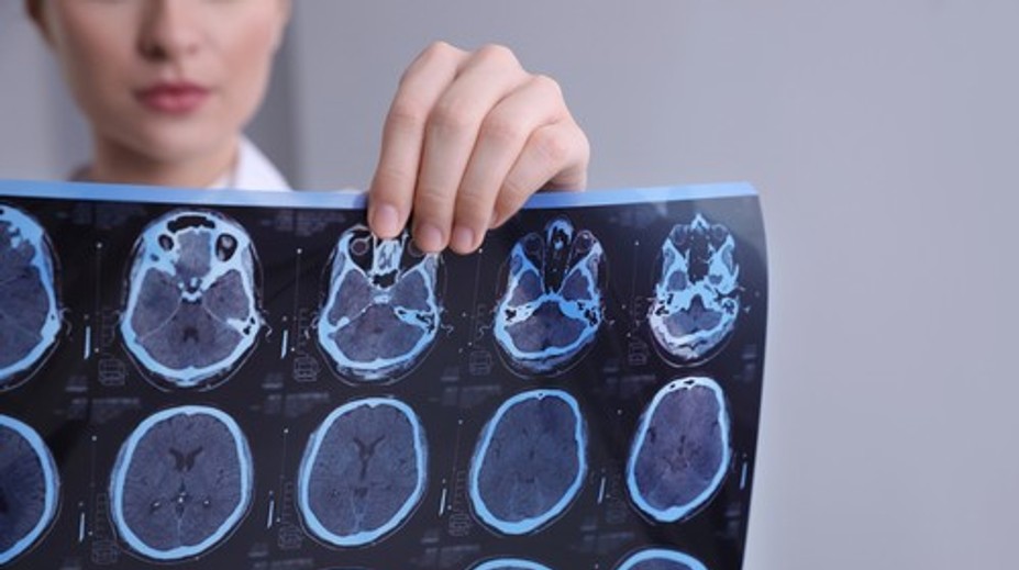 Vedci odhalili bunky, ktoré ničia mozog. Objav môže zmeniť liečbu sklerózy