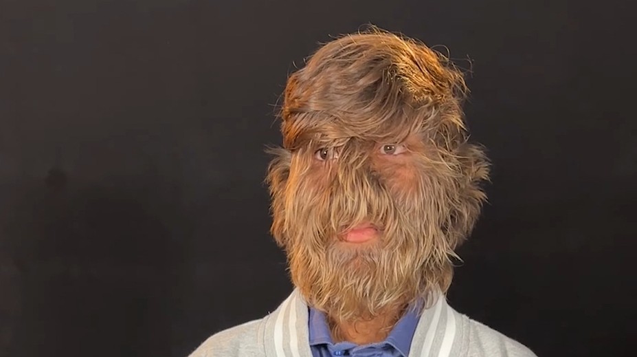 Mladík má vzácny vlkolačí syndróm. Získal vďaka tomu svetový rekord